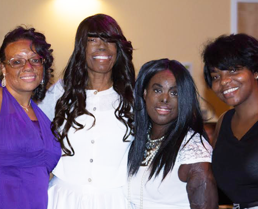 Healed with Scars, Burn Victims, Scarring from Burns, Support Group, Philadelphia, Pennsylvania, New Jersey, Rosemary Washington